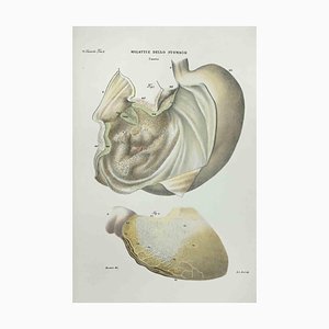 Ottavio Muzzi, Stomach Diseases, Lithograph, 1843
