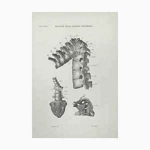 Ottavio Muzzi, Vertebral Column Diseases, Lithograph, 1843