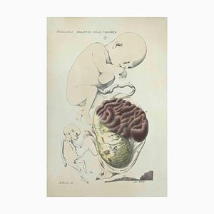 Ottavio Muzzi, Diseases of the Plannta, Lithograph, 1843