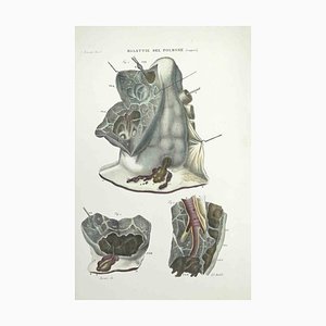Ottavio Muzzi, Lung Diseases, Lithograph, 1843