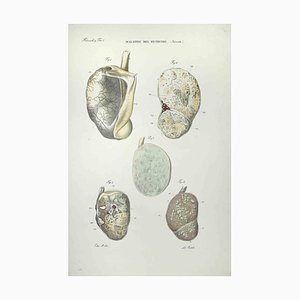 Ottavio Muzzi, Testicular Diseases, Lithograph, 1843
