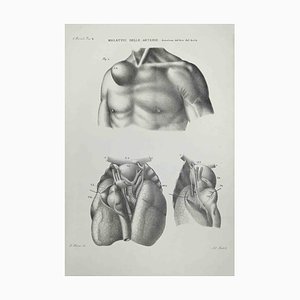 Ottavio Muzzi, Diseases of the Arteries, Lithograph, 1843