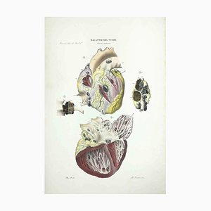 Ottavio Muzzi, Maladies cardiaques, Lithographie, 1843