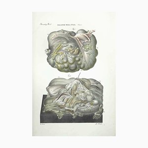 Ottavio Muzzi, Diseases of the Ovary, Lithograph, 1843