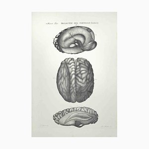 Ottavio Muzzi, Brain Diseases, Lithograph, 1843