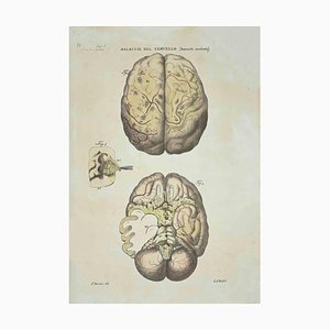 Ottavio Muzzi, Brain Diseases, Lithograph, 1843