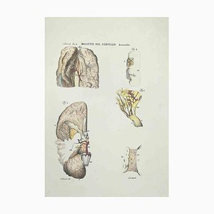 Ottavio Muzzi, Gehirnkrankheiten, Lithographie, 1843