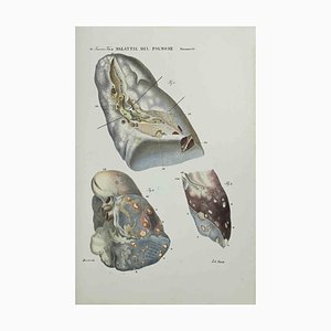 Ottavio Muzzi, Lung Diseases, Lithograph, 1843