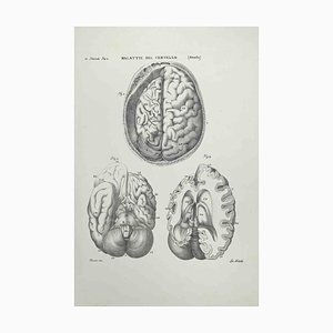 Ottavio Muzzi, Maladies du Cerveau, Lithographie, 1843