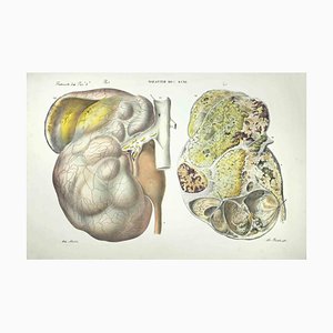 Ottavio Muzzi, Kidney Diseases, Lithograph, 1843