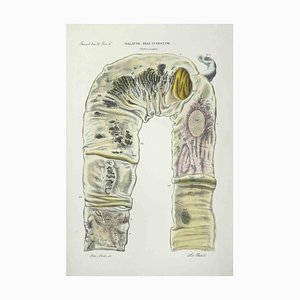 Ottavio Muzzi, Bowel Diseases, Lithograph, 1843