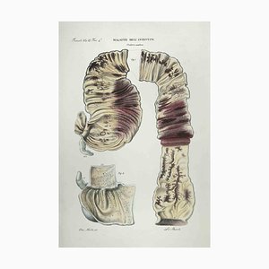 Ottavio Muzzi, Bowel Diseases, Lithograph, 1843