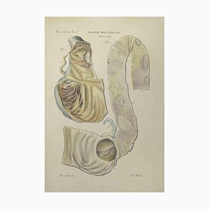 Ottavio Muzzi, Bowel Diseases, Lithograph, 1843