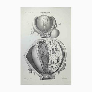 Ottavio Muzzi, Uterus Diseases, Lithograph, 1843