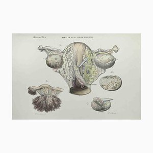 Ottavio Muzzi, Uterus Disease, Lithographie, 1843