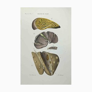 Ottavio Muzzi, Liver Disease, Lithograph, 1843