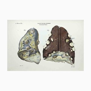 Ottavio Muzzi, Lung Diseases, Lithograph, 1843