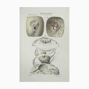 Ottavio Muzzi, Brain Diseases, Lithograph, 1843