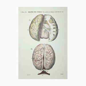 Ottavio Muzzi, Gehirnkrankheiten, Lithographie, 1843