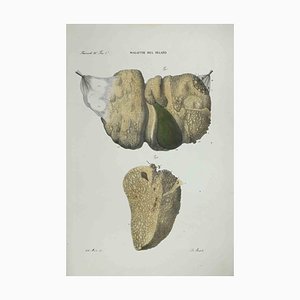 Ottavio Muzzi, Liver Diseases, Lithograph, 1843
