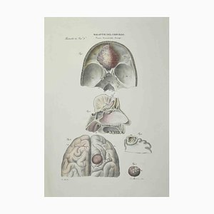 Ottavio Muzzi, Brain Diseases, Lithograph, 1843