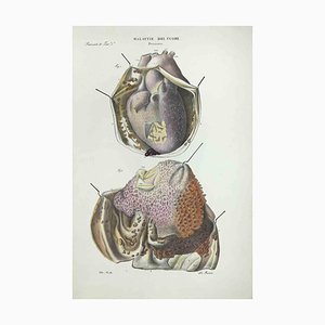 Ottavio Muzzi, Heart Diseases, Lithograph, 1843