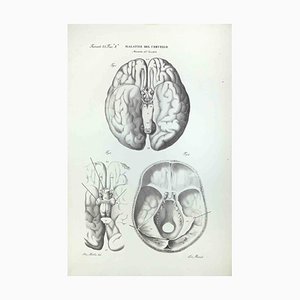 Ottavio Muzzi, Gehirnkrankheiten, Lithographie, 1843