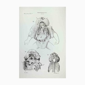 Ottavio Muzzi, Fetus Diseases, Lithograph, 1843