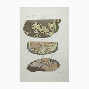 Ottavio Muzzi, Liver Diseases, Lithograph, 1843