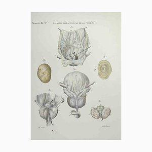 Ottavio Muzzi, Bladder and Prostate Diseases, Lithograph, 1843