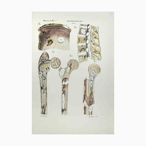 Ottavio Muzzi, Bone Diseases, Lithograph, 1843
