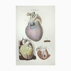 Ottavio Muzzi, Heart Diseases, Lithograph, 1843