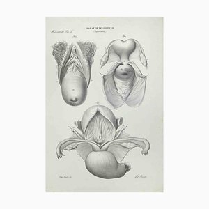 Ottavio Muzzi, Uterus Diseases, Lithograph, 1843