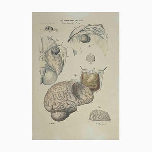 Ottavio Muzzi, Brain Diseases, Lithograph, 1843