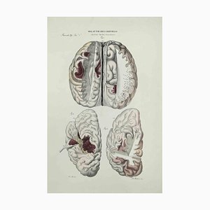 Ottavio Muzzi, Brain Diseases, Lithograph, 1843