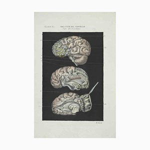 Ottavio Muzzi, Brain Diseases, Lithograph, 1843