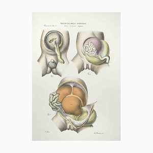 Ottavio Muzzi, Diseases of the Intestines, Lithograph, 1843