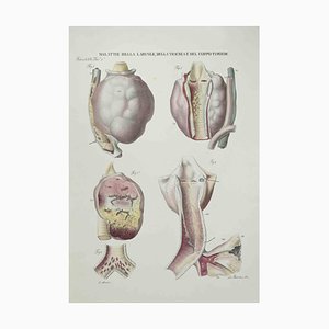 Ottavio Muzzi, Diseases of the Larynx, Trachea and Thyroid, Lithograph, 1843