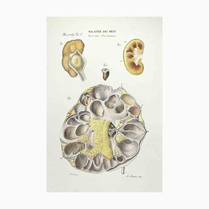Ottavio Muzzi, Kidney Diseases, Lithograph, 1843