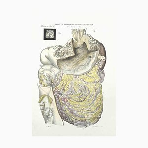 Ottavio Muzzi, Disease of the Stomach of Epiploon, Lithograph, 1843