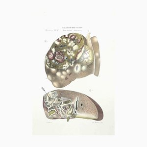 Ottavio Muzzi, Liver Diseases, Lithograph, 1843