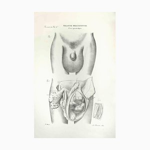 Ottavio Muzzi, Diseases of the Intestines, Lithograph, 1843