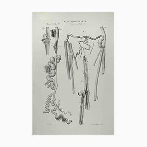 Ottavio Muzzi, Maladies des veines, Lithographie, 1843