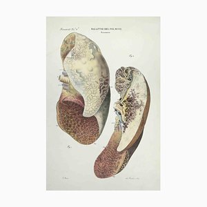 Ottavio Muzzi, Lung Diseases, Lithograph, 1843