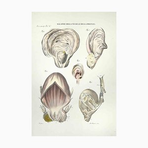 Ottavio Muzzi, Bladder and Prostate Diseases, Lithograph, 1843