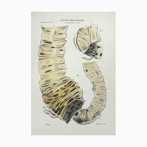 Ottavio Muzzi, Diseases of the Intestines, Lithograph, 1843