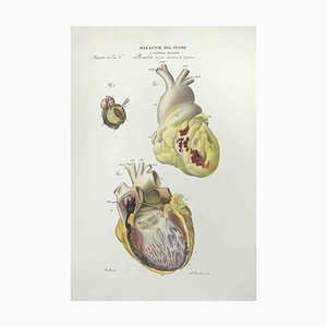 Ottavio Muzzi, Heart Diseases, Lithograph, 1843