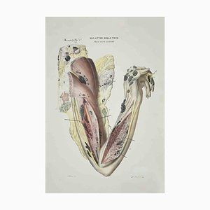 Ottavio Muzzi, Vein Diseases, Lithograph, 1843