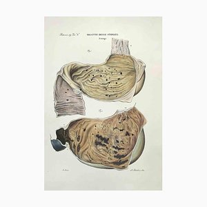 Ottavio Muzzi, Stomach Diseases, Lithograph, 1843