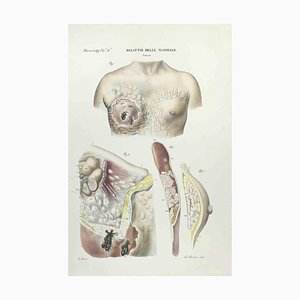Ottavio Muzzi, Breast Diseases, Lithograph, 1843